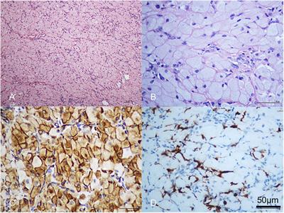 From prenatal diagnosis to surgical treatment: two case reports of congenital granular cell epulis